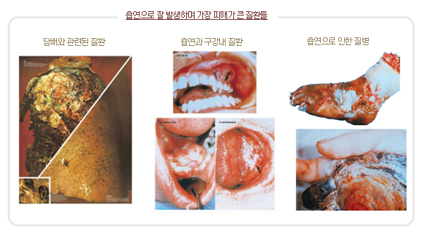 흡연으로 잘 발생하며 가장 피해가 큰 질환들 이미지